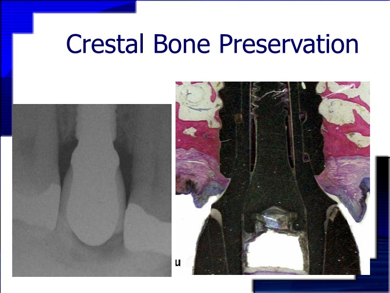 Crestal Bone Preservation